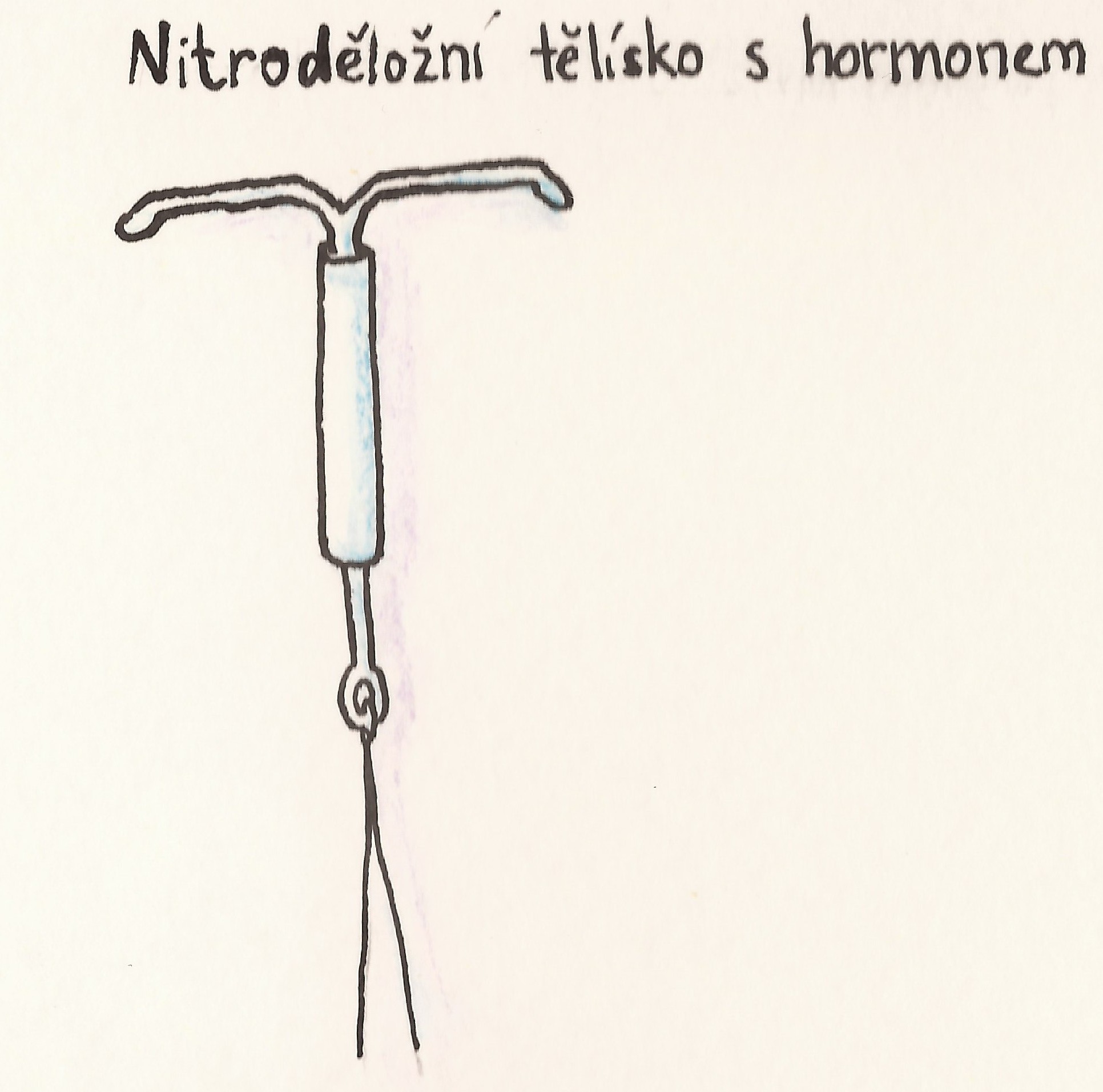 antikoncepce nitrodelozni telisko s hormonem